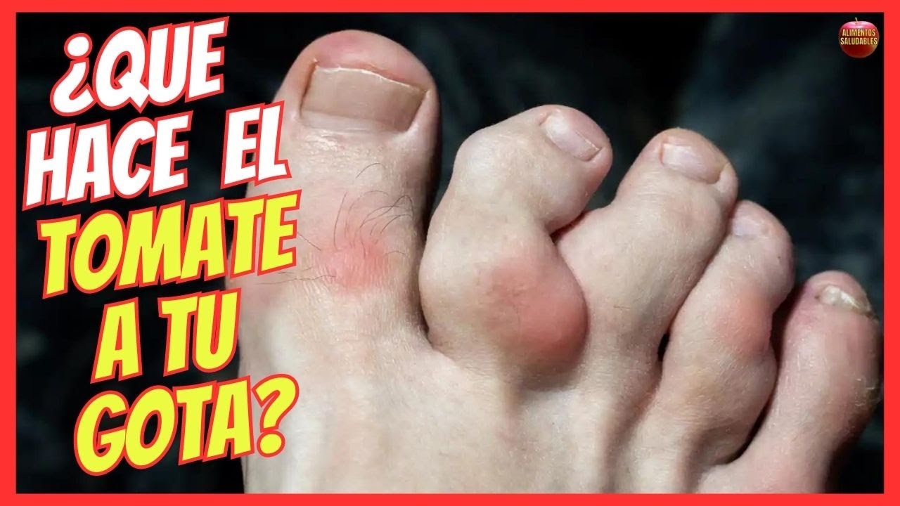 el tomate es malo para la gota